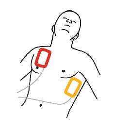 Physio Control CR2 elektroder vuxen placering